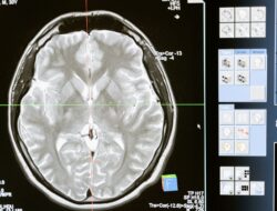 Awas! Ini Alasan Neurodegeneratif Bikin Otak Pria Cepat Menyusut