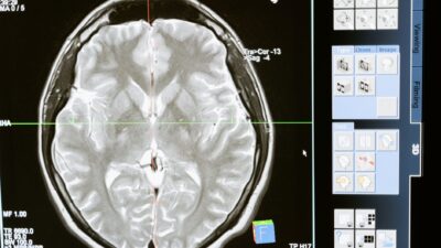 Ilustrasi otak pria yang mengalami neurodegeneratif dan menyusut.